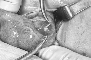 Bé trai 2 tuổi bị xương cá dài 4cm đâm thủng ruột