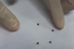 Bé trai 6 tuổi thủng ruột do nuốt 4 viên nam châm