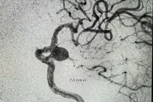 TP Cần Thơ: Can thiệp thành công túi phình mạch não lớn cho cụ bà 90 tuổi