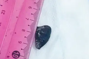 Hạt sapôchê trong phế quản người đàn ông được các bác sĩ lấy ra