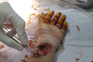 Bé trai 9 tuổi bị kính cắt động mạch tay trong lúc vui đùa