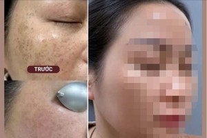 在社交网络上用于招揽顾客的激光治疗前－后对比广告图片。（截图）