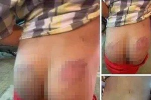 Học sinh P.H.K. bị giáo viên đánh bầm tím