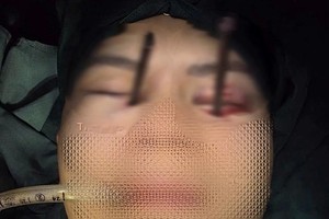 异物为两根深度刺入眼眶的筷子。图：医院提供