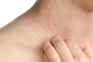 Cảnh báo dị ứng kim loại 