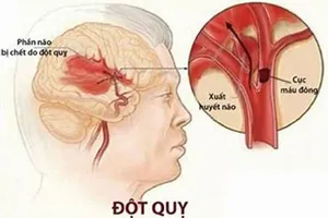 Mối liên hệ tăng huyết áp và đột quỵ