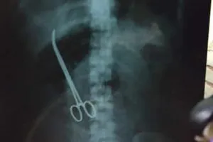 Lấy kéo bỏ quên trong ổ bụng bệnh nhân