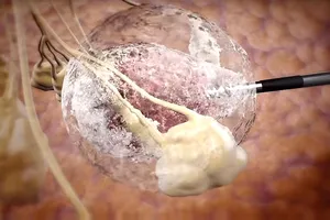 Diệt khối u bằng công nghệ nhiệt động