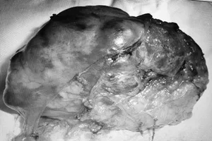 Khối u sau khi được lấy ra khỏi cơ thể bệnh nhân