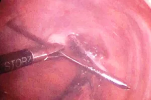 Hy hữu đinh dài 12 cm đâm xuyên đỉnh phổi chui vào tủy sống...vẫn sống