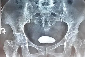 Vòng tránh thai đi lạc vào bàng quang tạo ra sỏi khủng