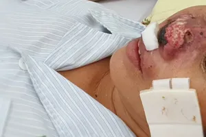 Vi khuẩn Whitmore “ăn thịt” làm nhiều người mắc và tử vong