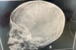 Bé gái bị 9 chiếc đinh ghim vào đầu tiên lượng nặng, công an ráo riết điều tra