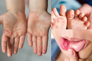 Gần 100.000 trẻ mắc tay chân miệng, Cục Phòng bệnh khuyến cáo khẩn