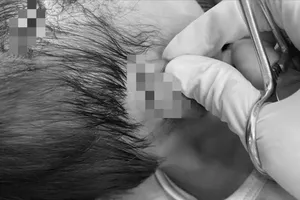 Các y, bác sĩ chữa trị cho bé gái bị chó cắn vào vùng đầu và mặt