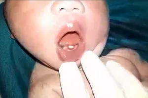 Một chiếc răng đã mọc lên ở hàm dưới của trẻ mới sinh