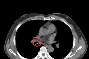 Dị vật ở lòng phế quản trung gian phổi phải qua hình ảnh chụp cắt lớp vi tính