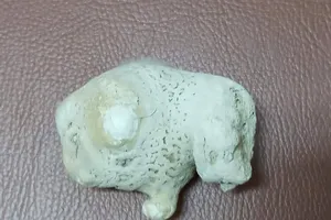 Kíp phẫu thuật lấy ra khối sỏi thận "khủng"