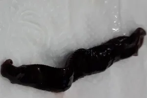 Con đỉa đã được gắp ra ngoài 