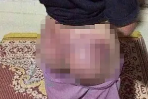Cháu G. bị đánh bầm tím mông