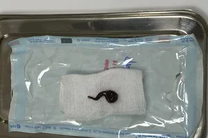 Con đỉa được gắp ra khỏi mũi bệnh nhân