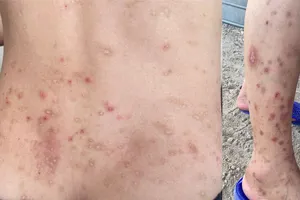 Vụ 126 người cùng thôn ở Hà Tĩnh đồng loạt viêm da: Do bọ chét