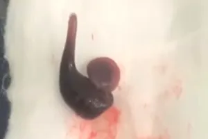 Con vắt đã được lấy ra ngoài 