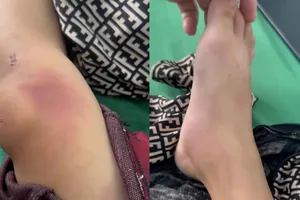 Xác minh thông tin bé gái bị đánh bầm tím phải nhập viện