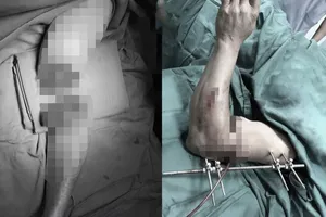 Hình ảnh trước và sau phẫu thuật. Ảnh: Bệnh viện Chấn thương Chỉnh hình Nghệ An