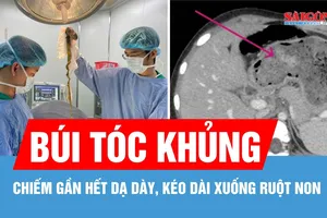 Phẫu thuật lấy búi tóc chiếm gần hết dạ dày, kéo dài xuống ruột non