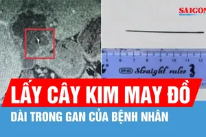 Hy hữu: Kim khâu dài 6cm nằm trong gan người đàn ông
