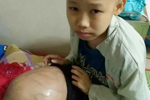 Bé bị ung thư xương, chân sưng to 