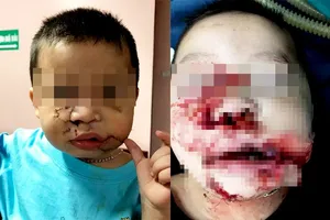Một cháu bé được phẫu thuật tạo hình vùng mặt sau khi bị chó nuôi cắn gây thương tích nặng