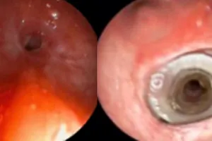 Hình ảnh nội soi trước và sau can thiệp