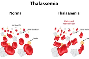 Nguy cơ mắc Thalassemia do thiếu máu, thừa sắt