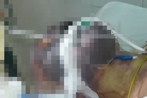 Một trường hợp bị nhiễm liên cầu khuẩn lợn