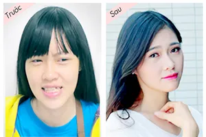 Hỗ trợ 70% chi phí phẫu thuật hàm mặt