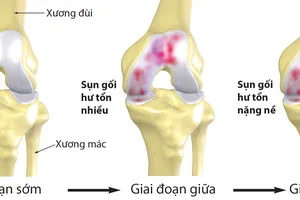 Bệnh nhân thoái hóa xương, khớp ngày càng trẻ hóa