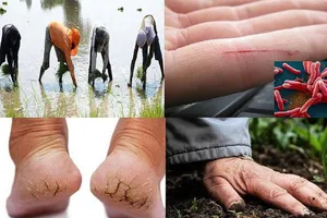 Tăng cường phòng chống bệnh Whitmore