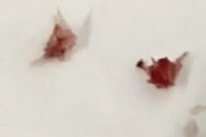 Các mảnh xương lươn được nội soi gắp ra ngoài thành công. Ảnh: BVCC