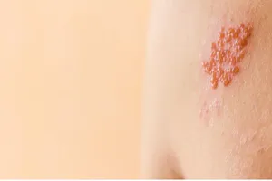 Số người khám các bệnh lý về da gia tăng