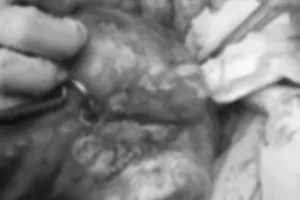 Cà Mau: Phẫu thuật thành công khối u đa nhân xơ tử cung nặng 2,1kg