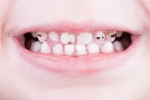 Dung dịch SDF 38% giúp ngăn sâu răng. Ảnh: CDM