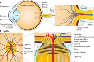 Phát hiện 40 chuỗi ADN mới gây bệnh tăng nhãn áp