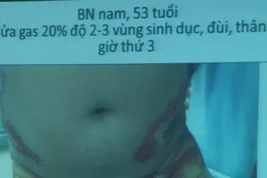 Bệnh nhân bị bỏng cấp độ 3, sâu, tổn thương, hoại tử da, nặng nhất là ở bộ phận sinh dục và hậu môn