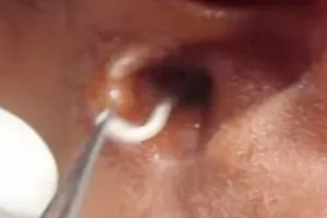 Kịp thời cứu chữa một bệnh nhi bị giòi làm tổ trong lỗ tai