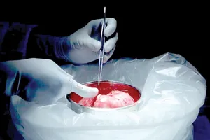 Ghép thận từ người hiến tạng nhiễm HIV còn sống