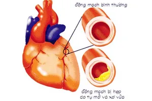 Chớ coi thường bệnh xơ vữa động mạch