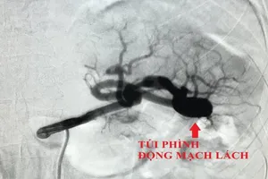 Cứu sống bệnh nhân bị phình động mạch lách