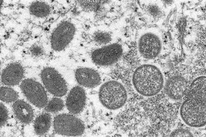 Mỹ tăng cường năng lực xét nghiệm bệnh đậu mùa khỉ